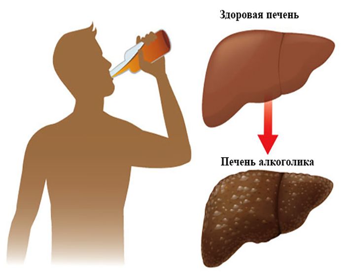 Жировая болезнь печени, связанная с алкоголем