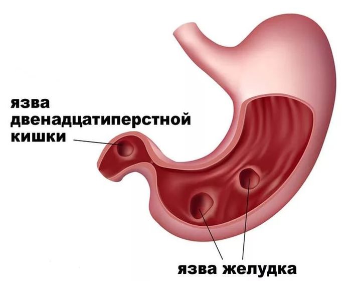 Борьба с язвой двенадцатиперстной кишки, советы от народной медицины