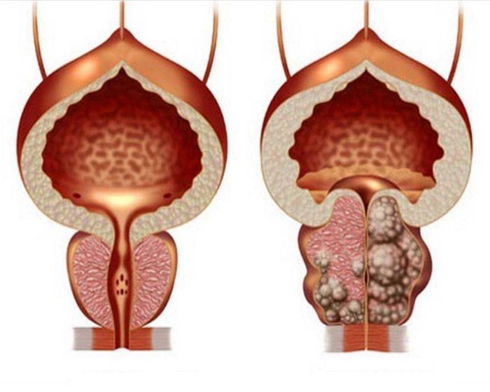 Первые признаки аденомы простаты, у мужчин