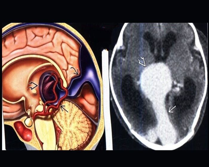 Аневризма вены Галена, рассказывают детские врачи